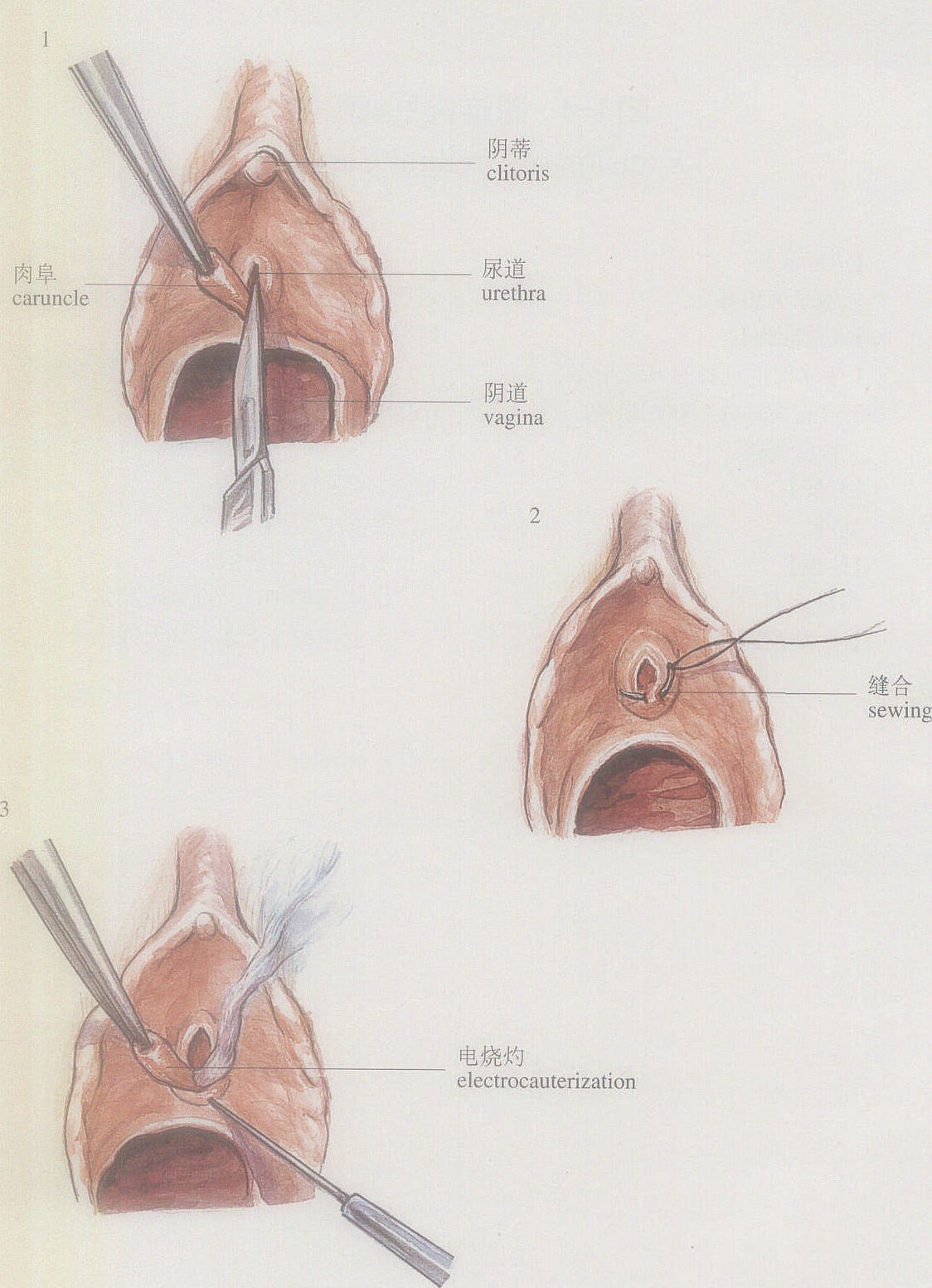 图1-4尿道肉阜切除术