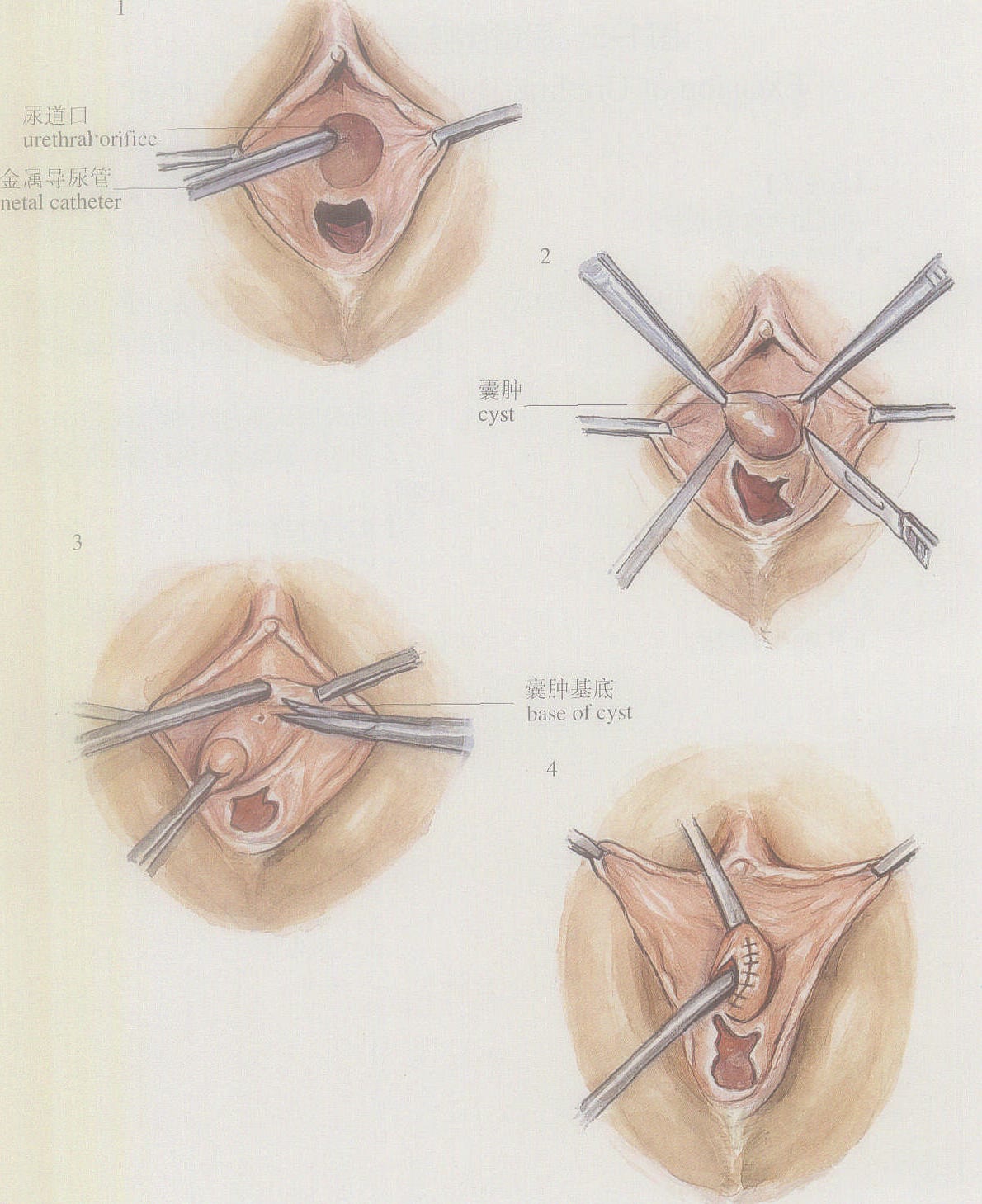 图1-5尿道旁腺囊肿切除术