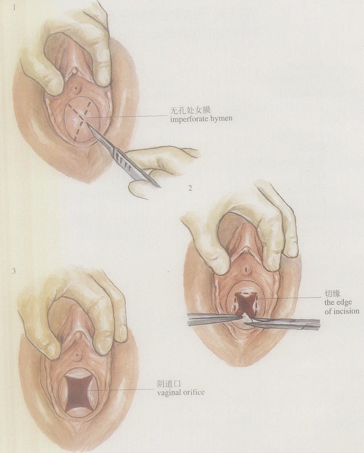 图1-6无孔处女膜切开术