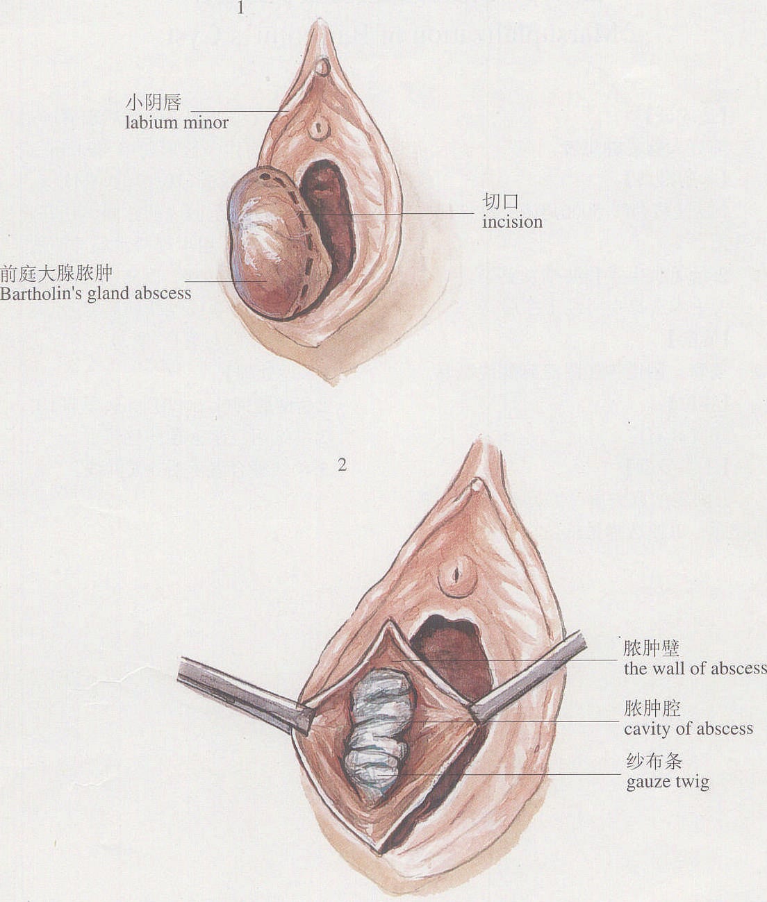 图1-8前庭大腺脓肿切开引流术