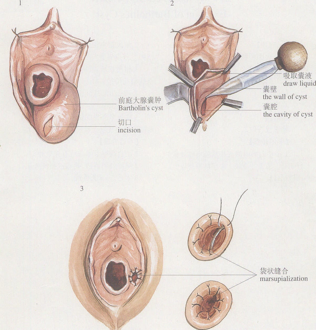 图1-9前庭大腺囊肿袋状缝合术