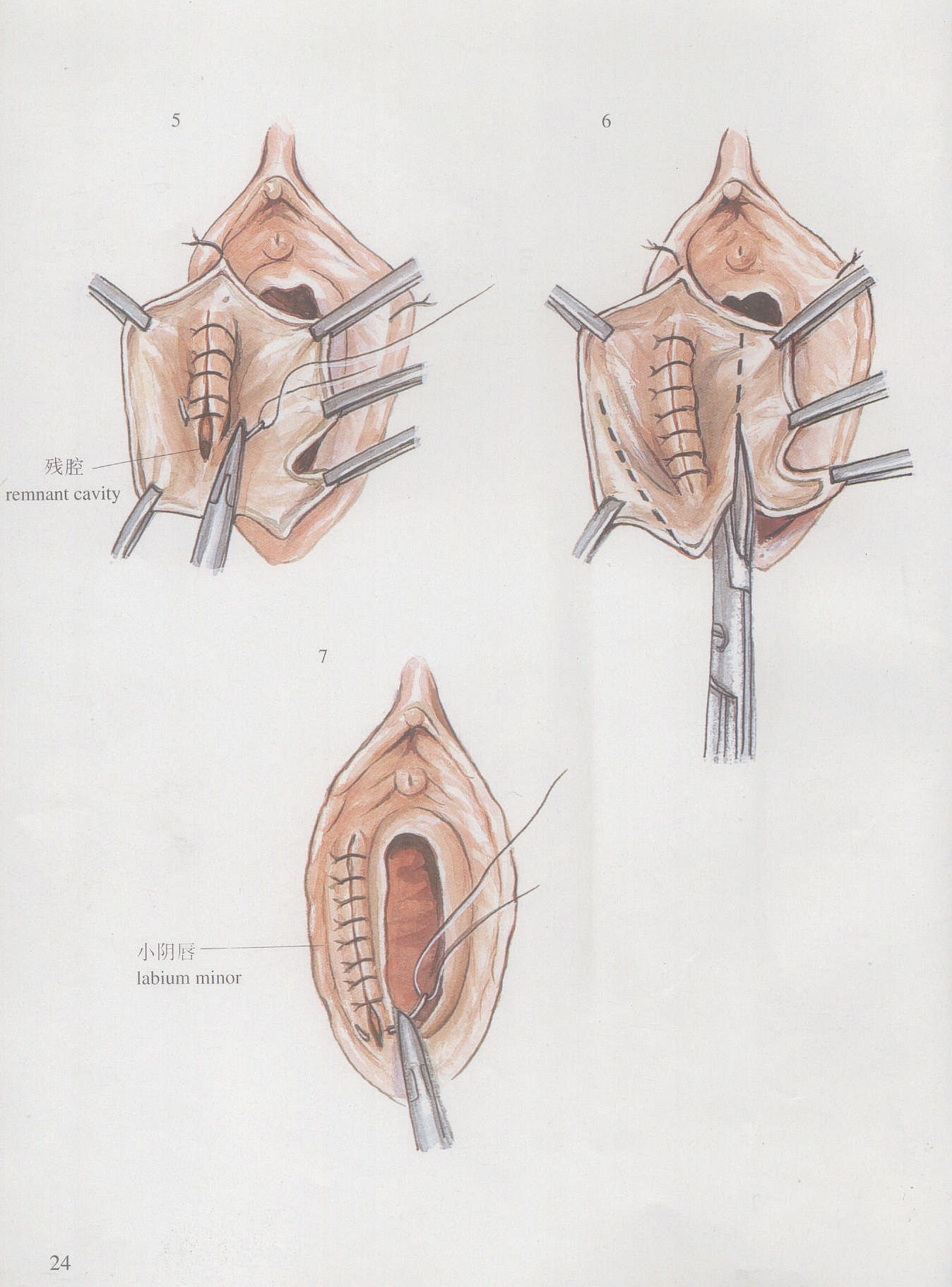 前庭大腺造口术步骤图片