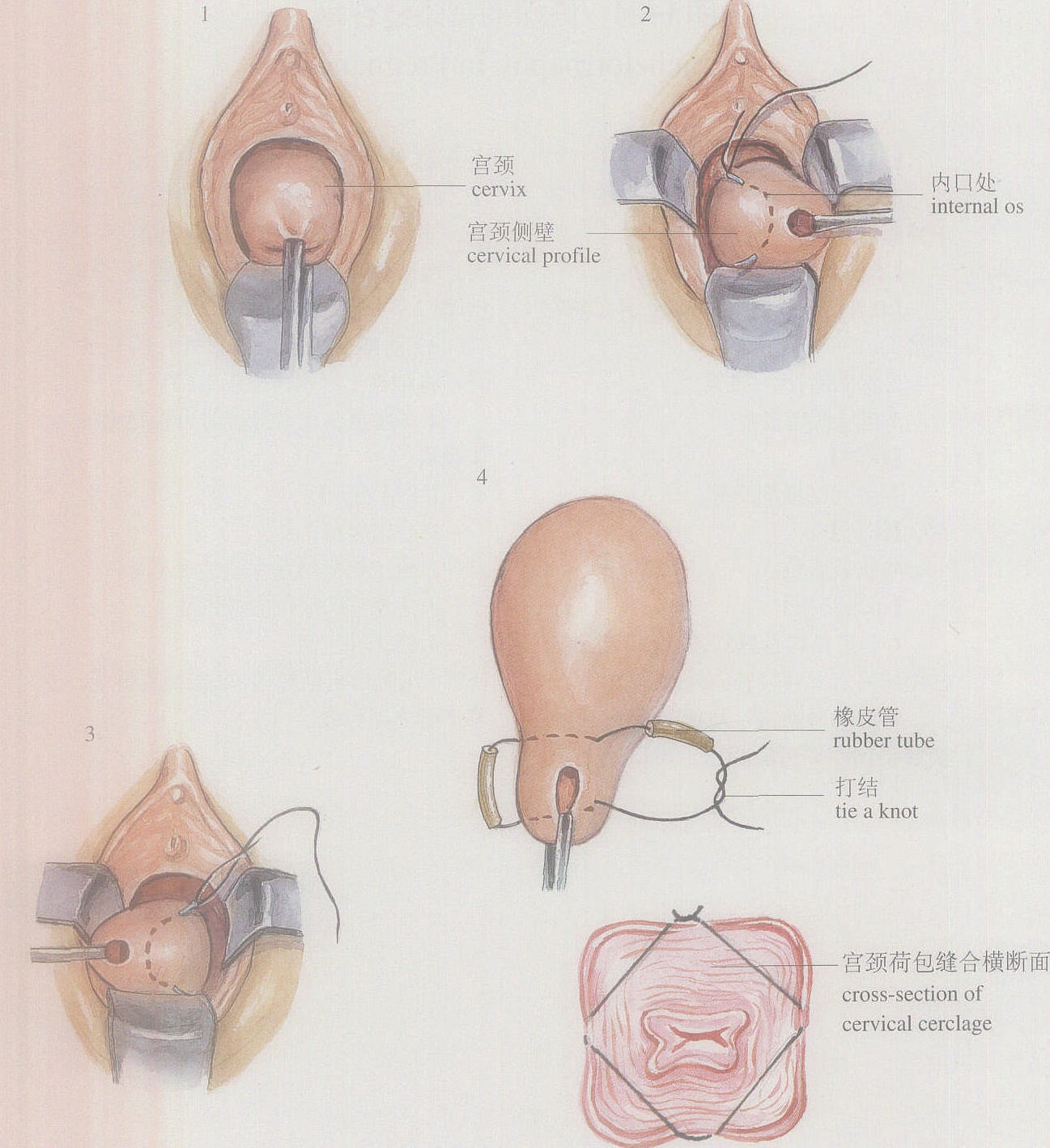 圖1-24妊娠期宮頸縫合術(shù)