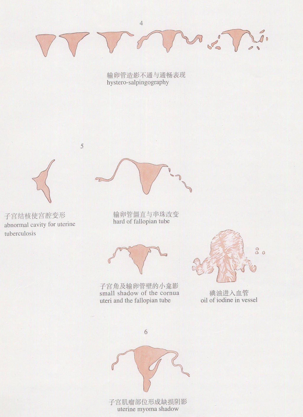 圖1-30輸卵管碘油造影術(shù)