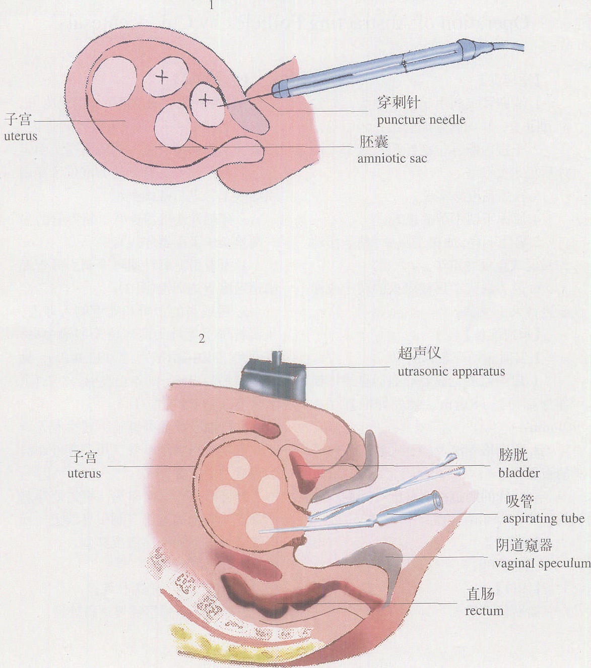羊膜腔穿刺术引产步骤图片