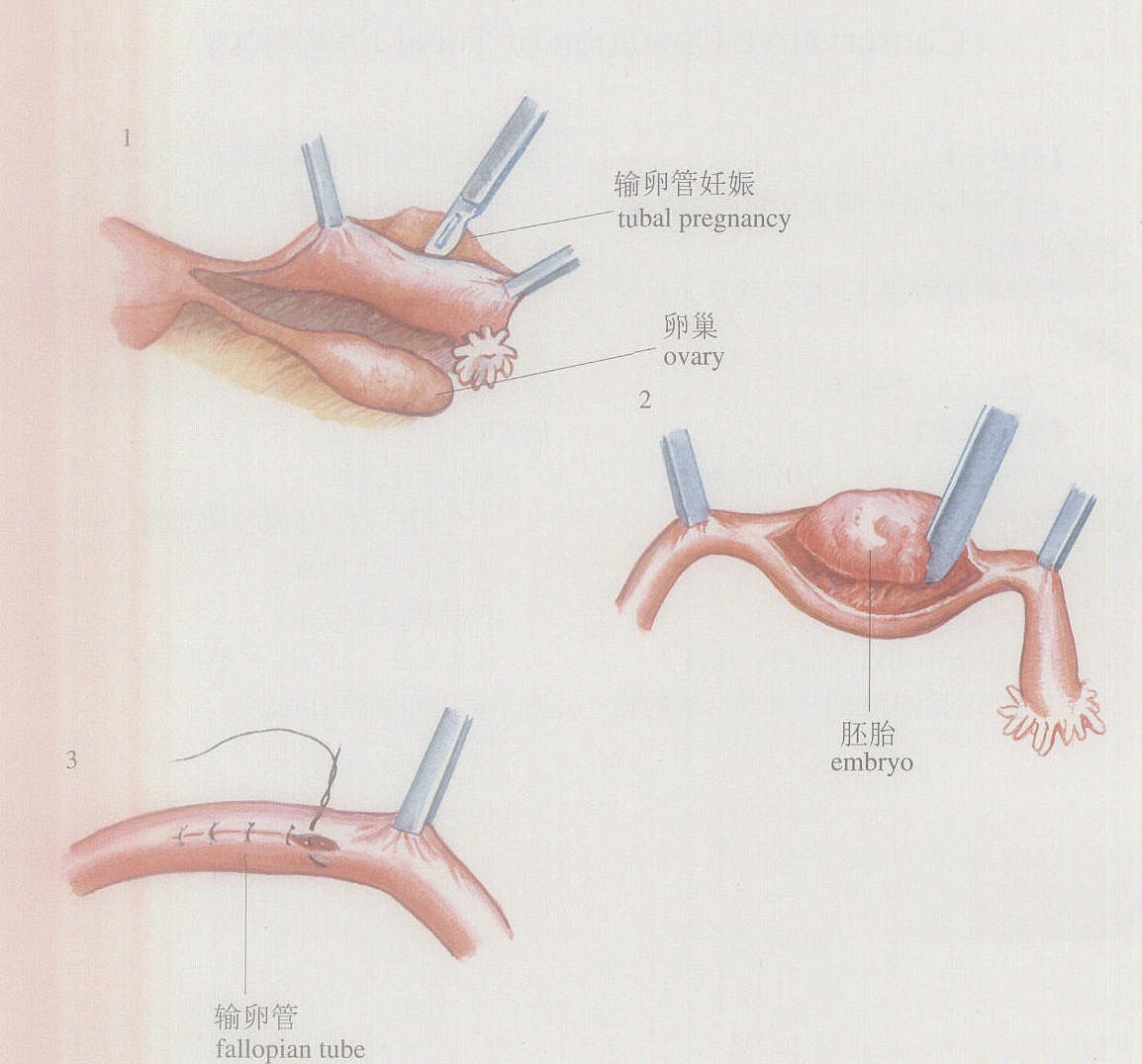 图3-18输卵管妊娠保守性手术