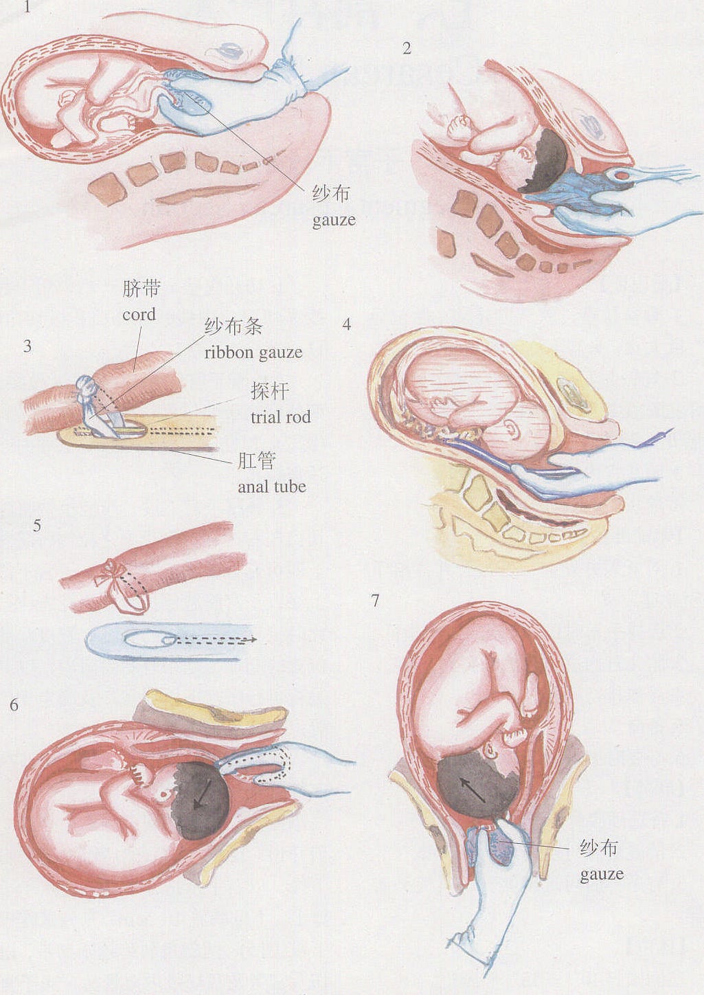 图4-15脐带脱垂的手术处理