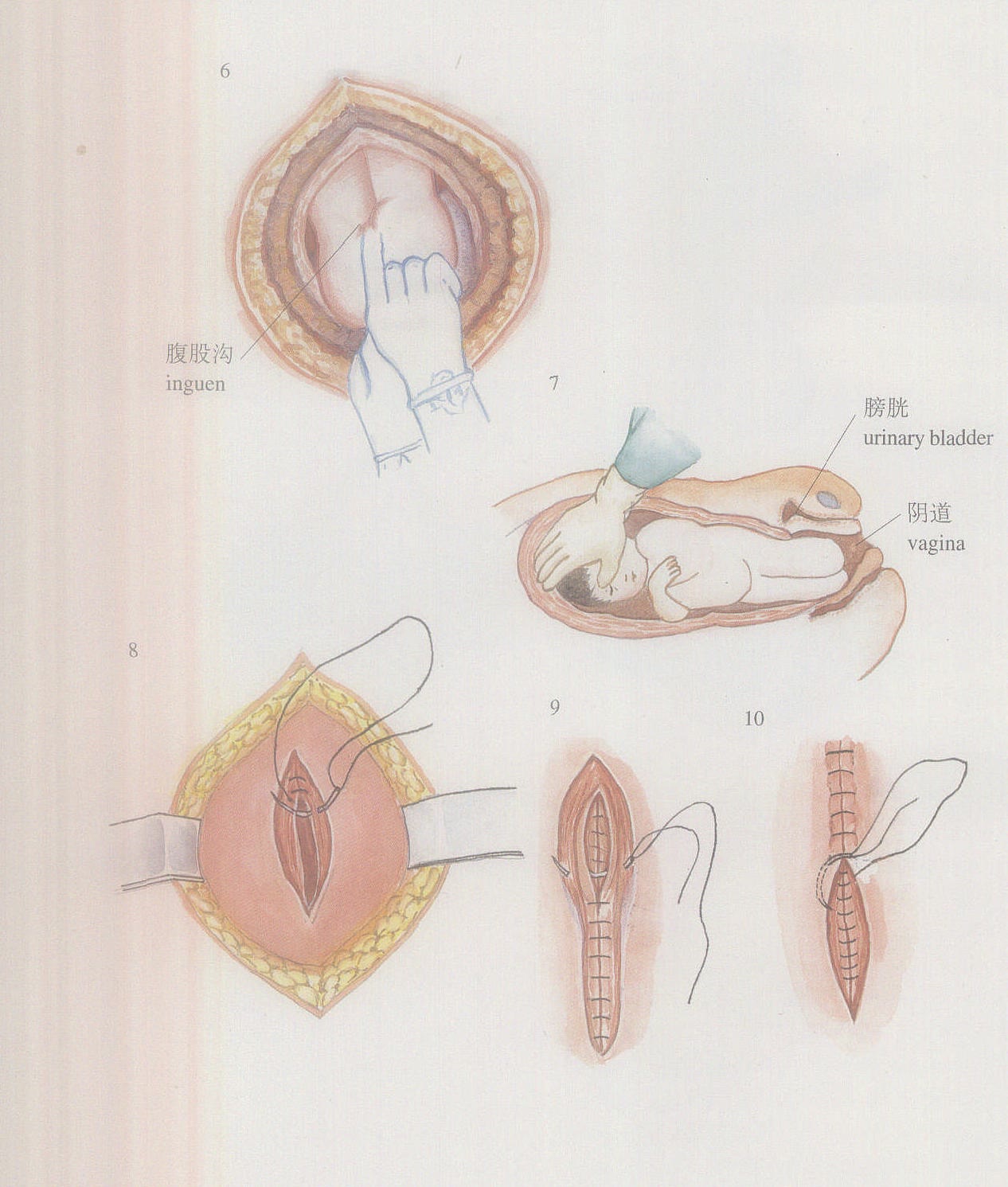 子宫背带式缝合术图片图片
