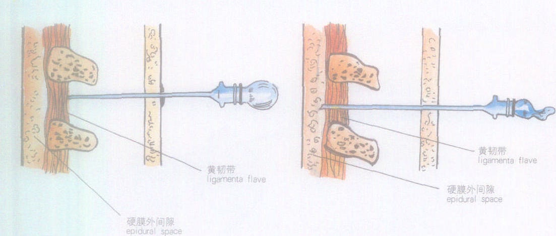 硬膜外麻醉解剖图图片