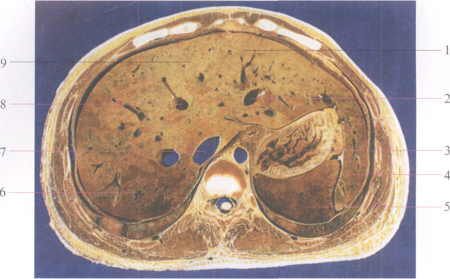 肝脏ct断层解剖图谱图片