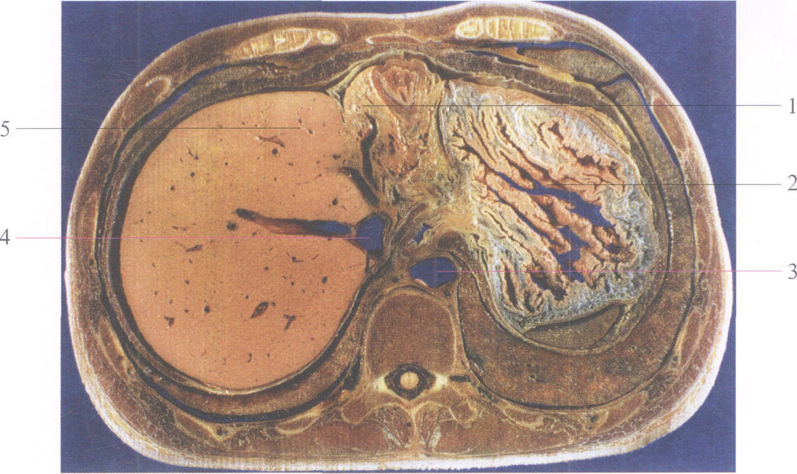 第一肝门横断面图片