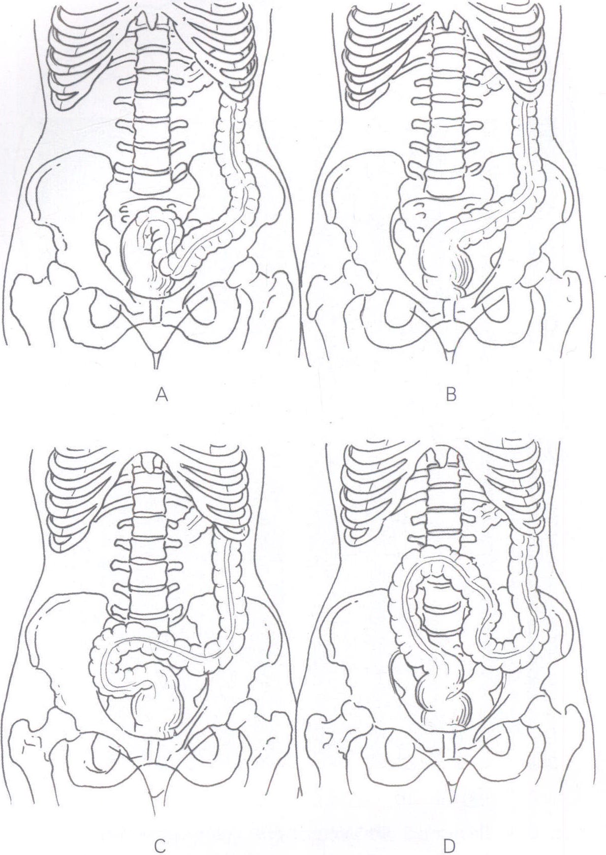图14-17 乙状结肠的位置变异