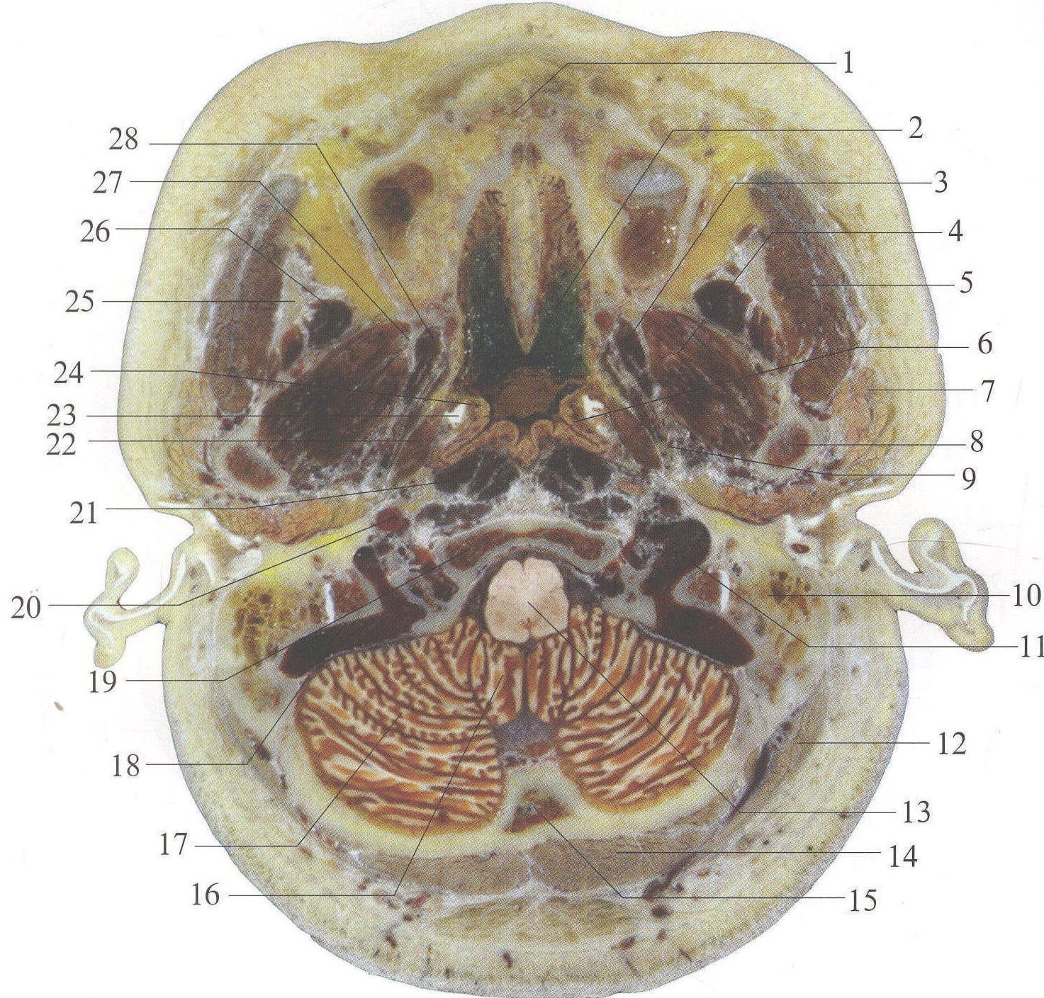 图1-1-25 咽隐窝层面