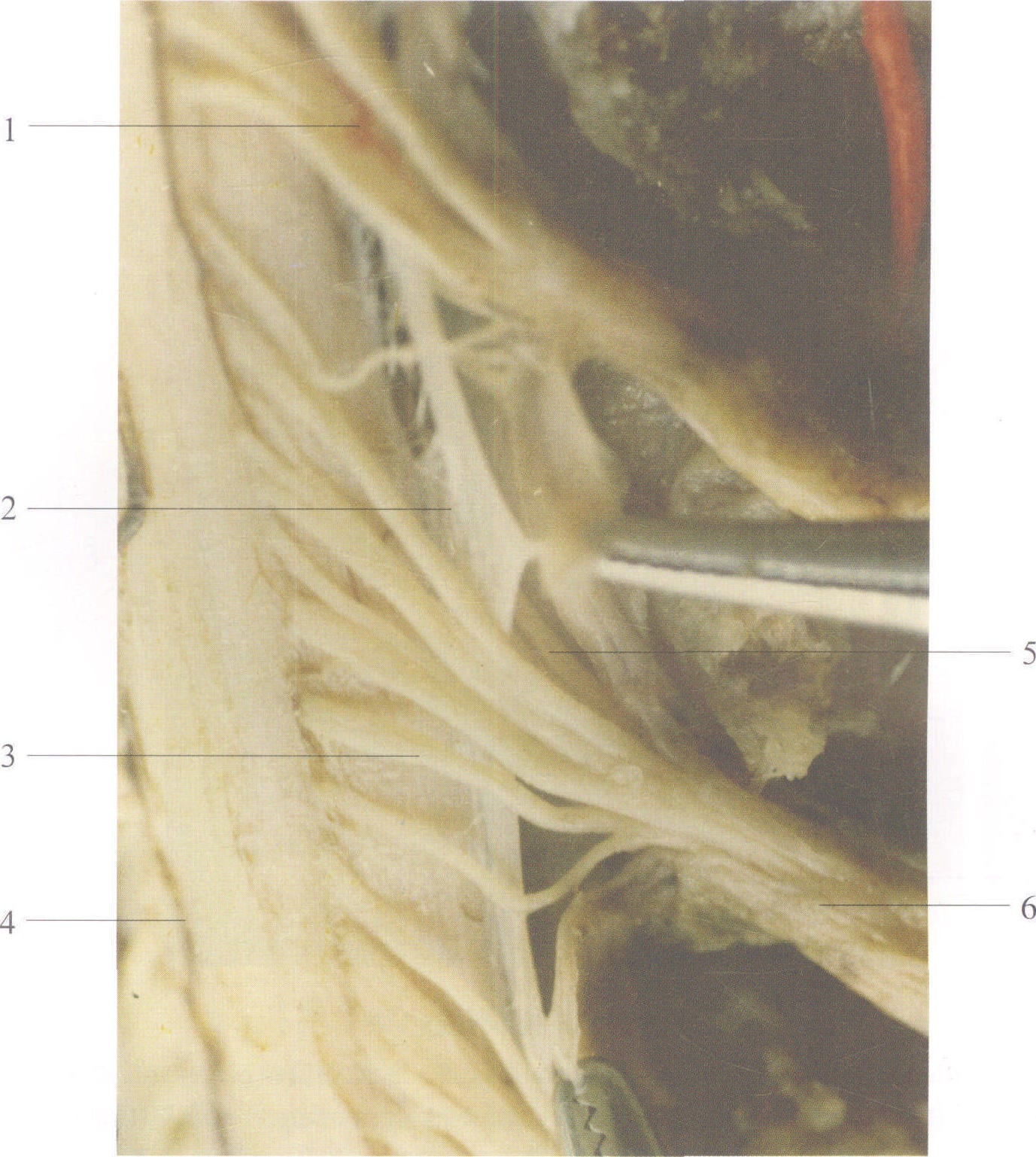 图2-62 齿状韧带(1)