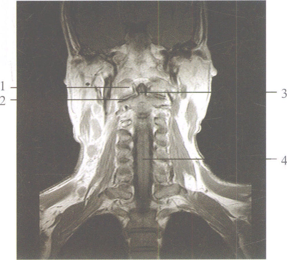 图2-111 颈部冠状面MRI像(1)