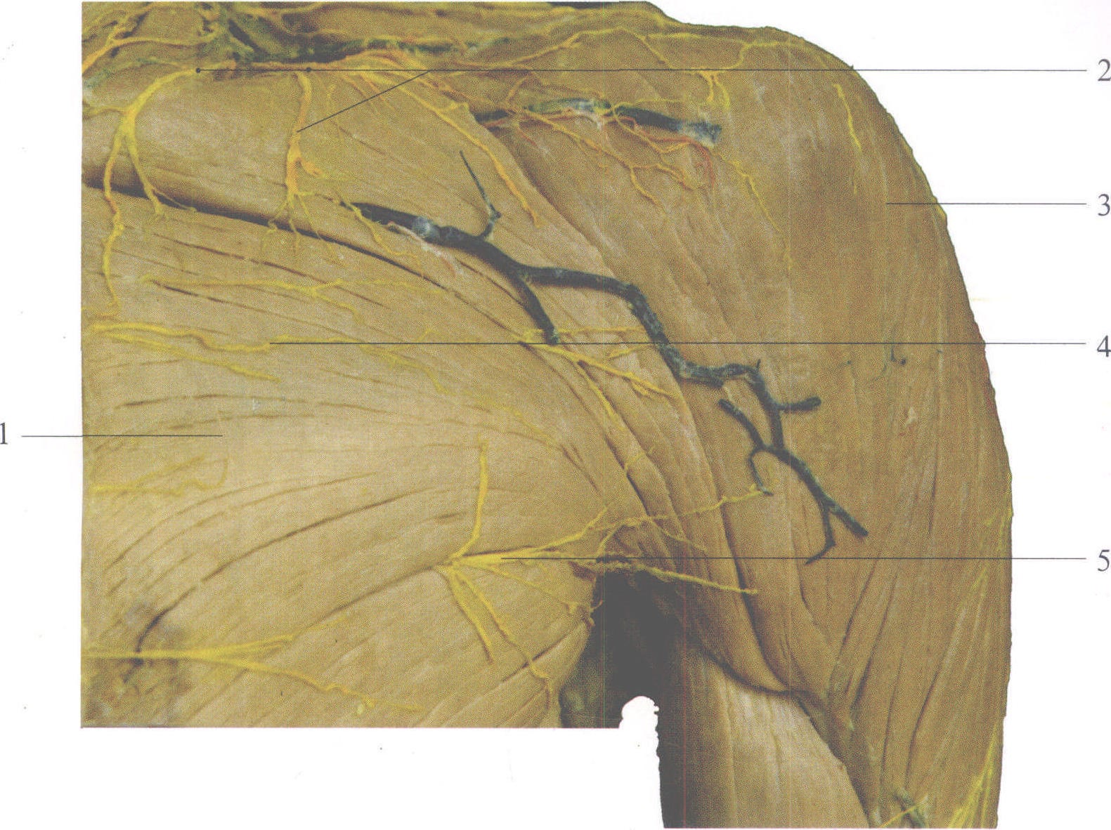 图3-42 胸前肌和皮神经