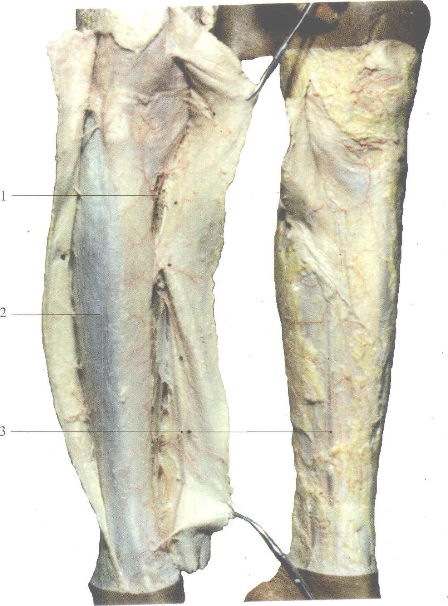 图4-127 小腿内侧血管、神经(4)-外科学-医学
