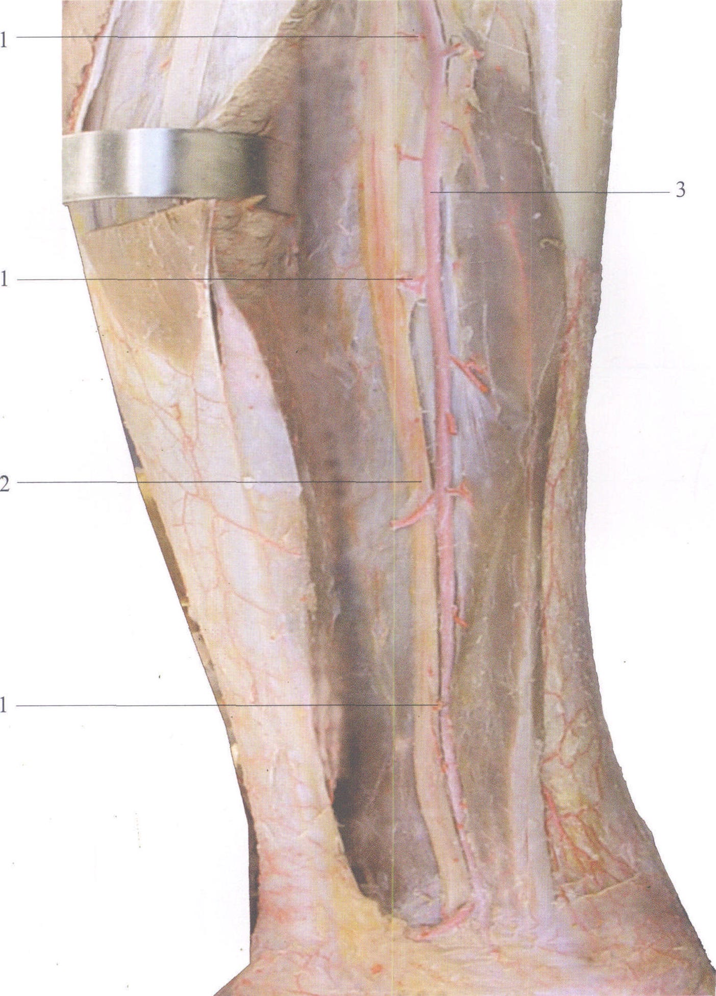 2胫神经tibialn3胫后动脉posteriortibiala