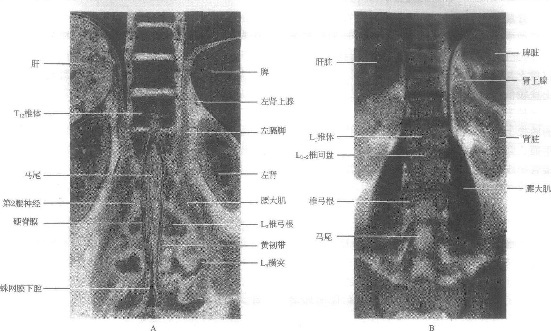 第三节 腰椎的mri解剖
