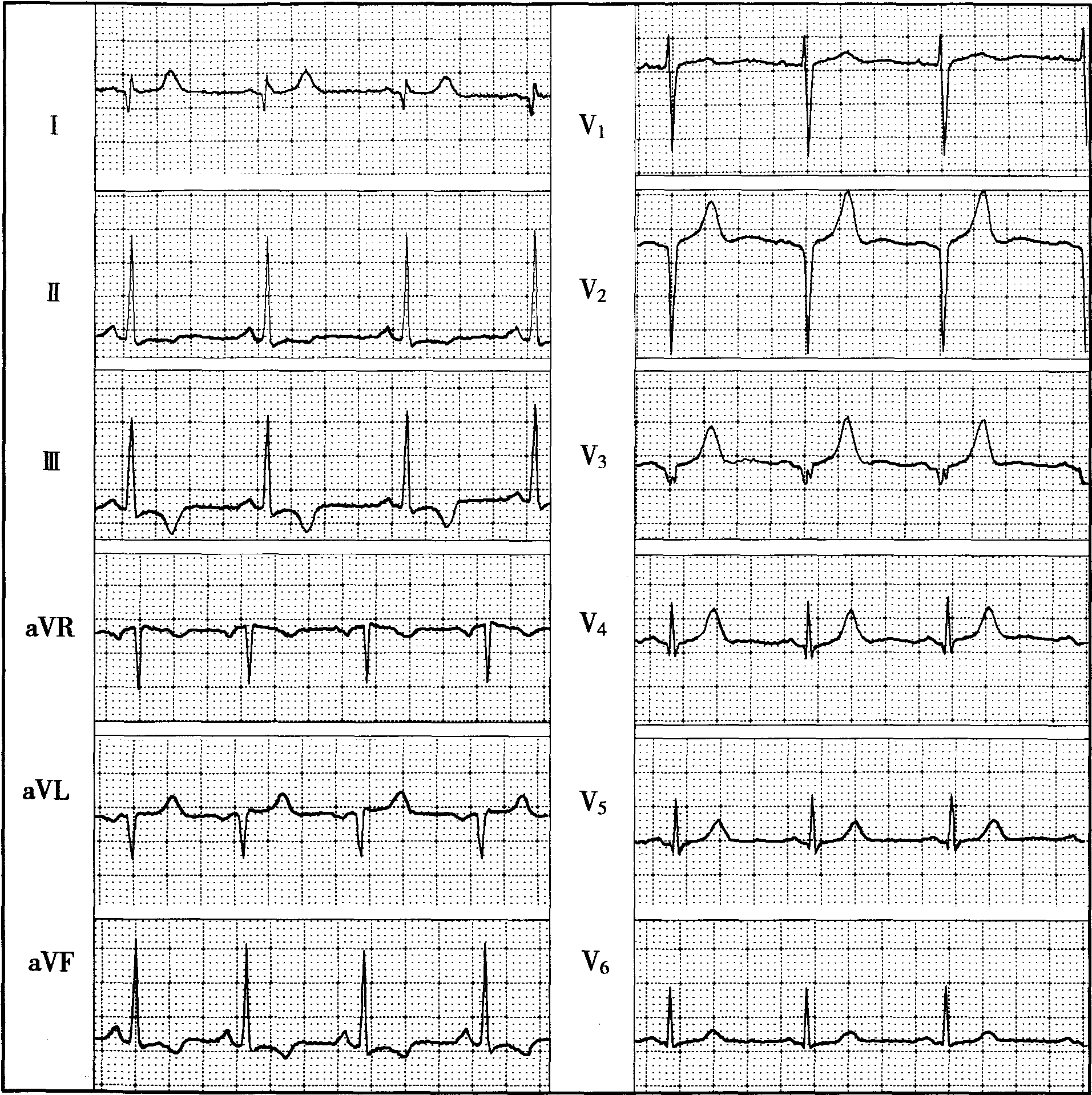 正常心电图v1导联t波图片