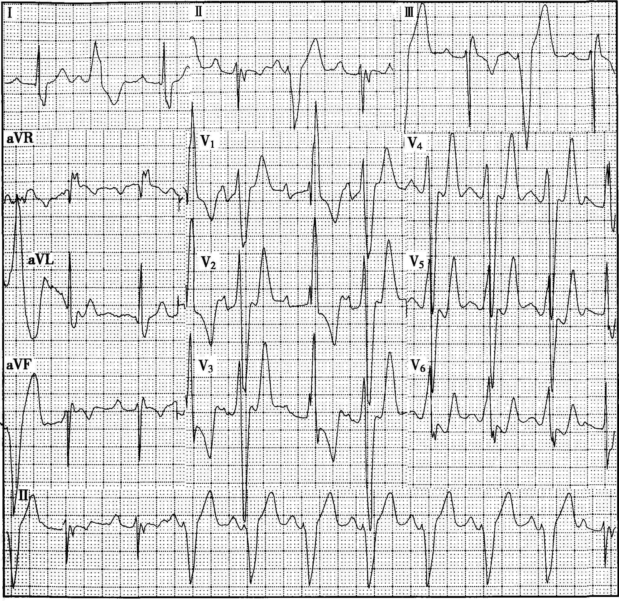 心电图v1呈m型图片