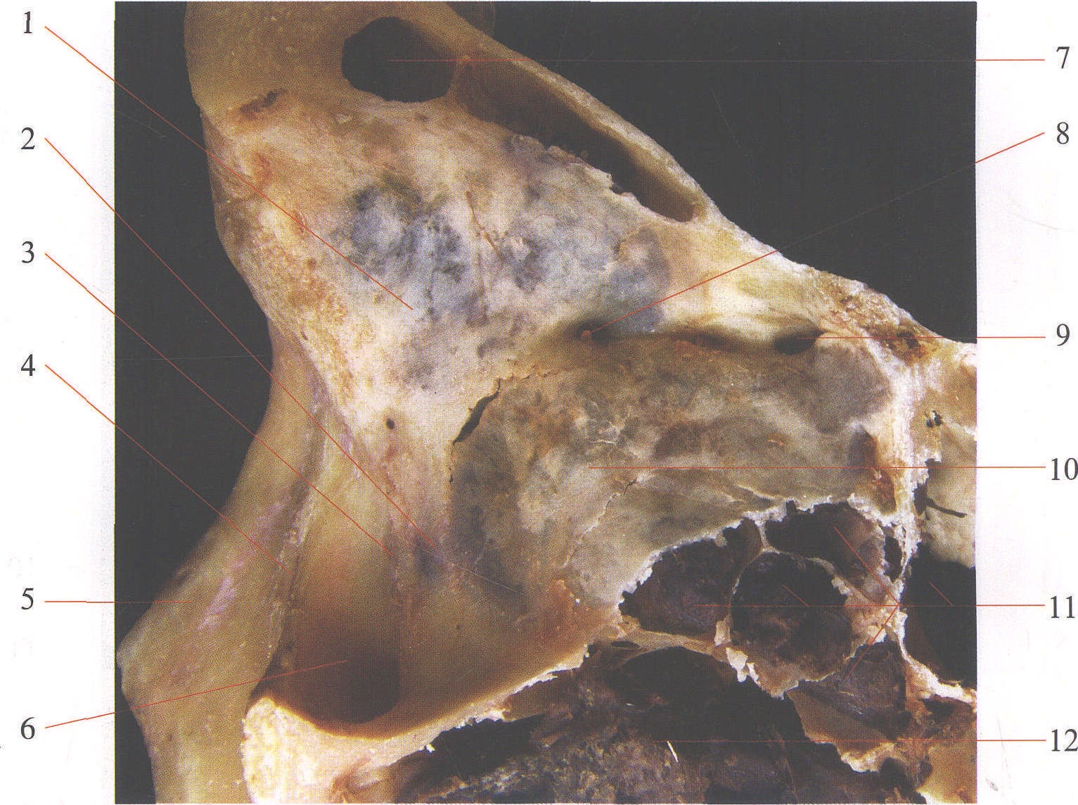 图1—3 骨性眶腔内侧壁