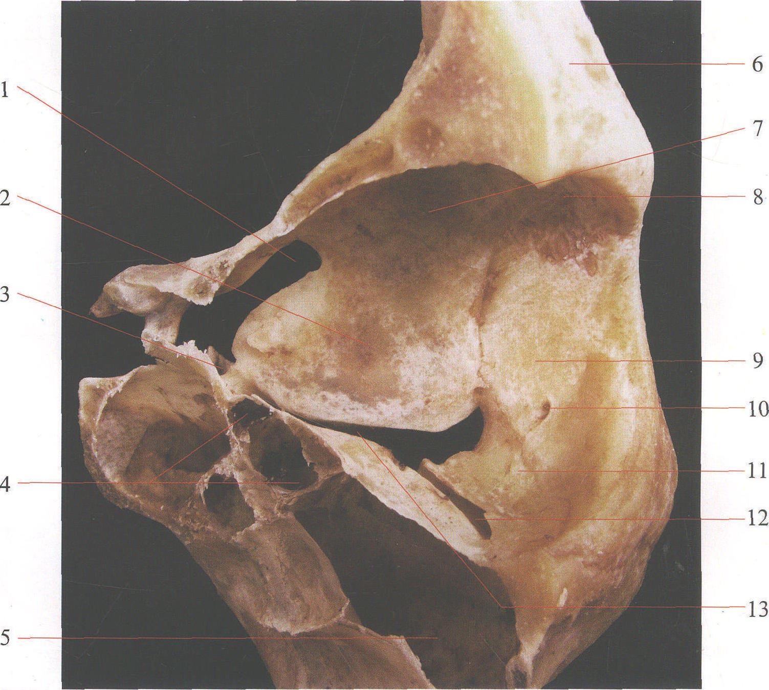 图1—4 骨性眶腔外侧壁