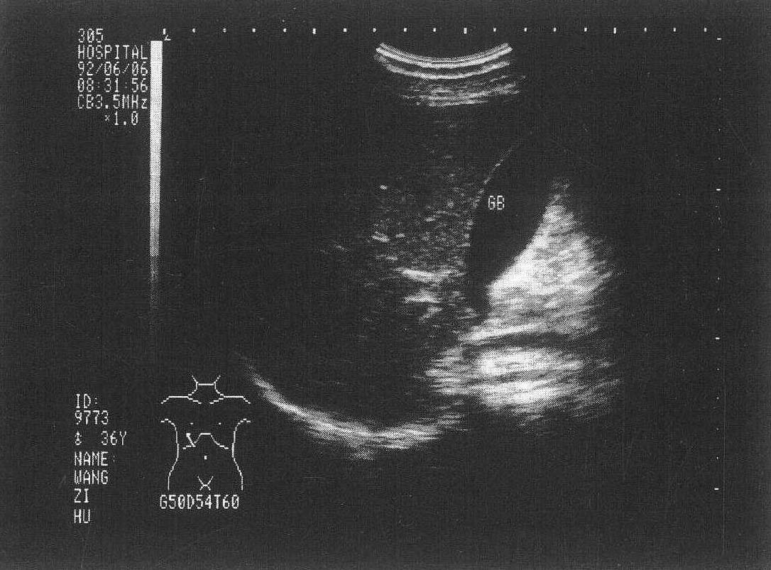 图2-1 正常胆囊声像图
