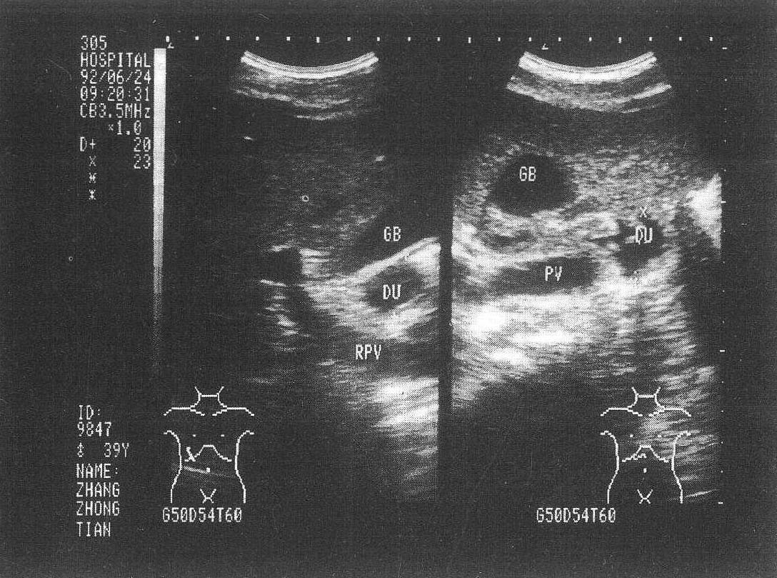 圖4-11 十二指腸潴留聲像圖