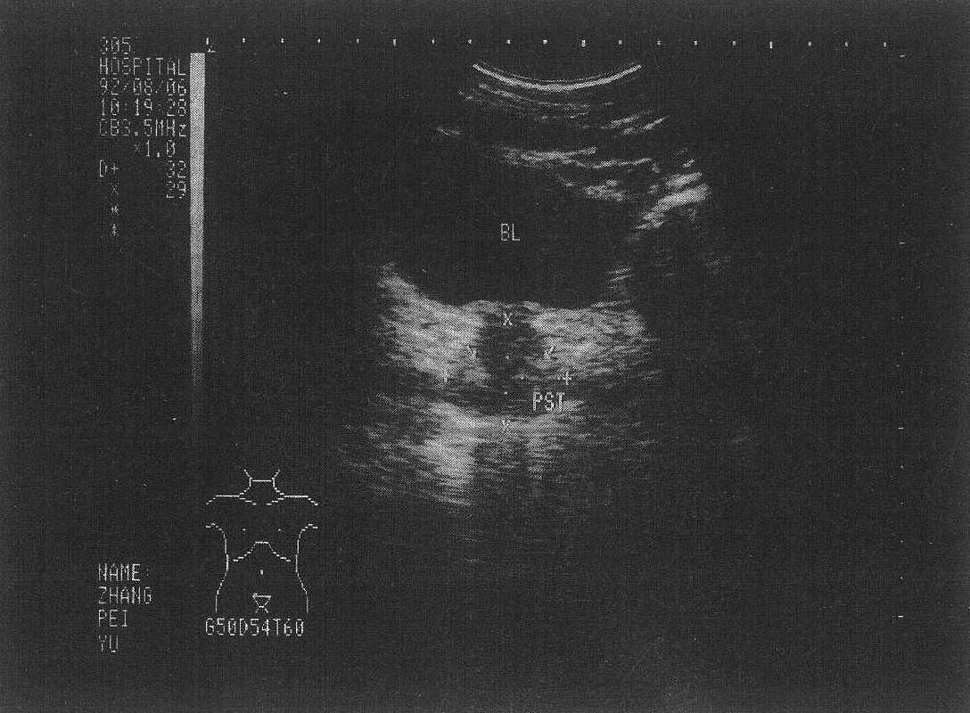 圖5-2 正常前列腺聲像圖