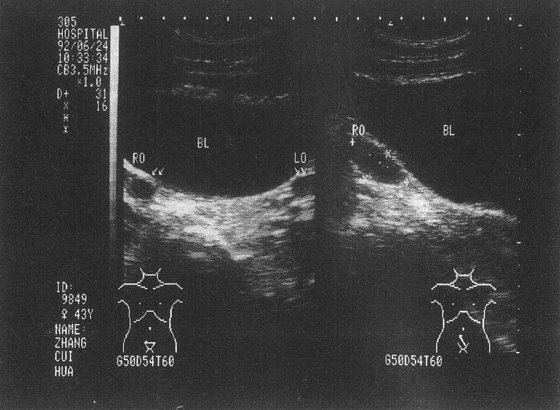 图6-2 正常卵巢声像图