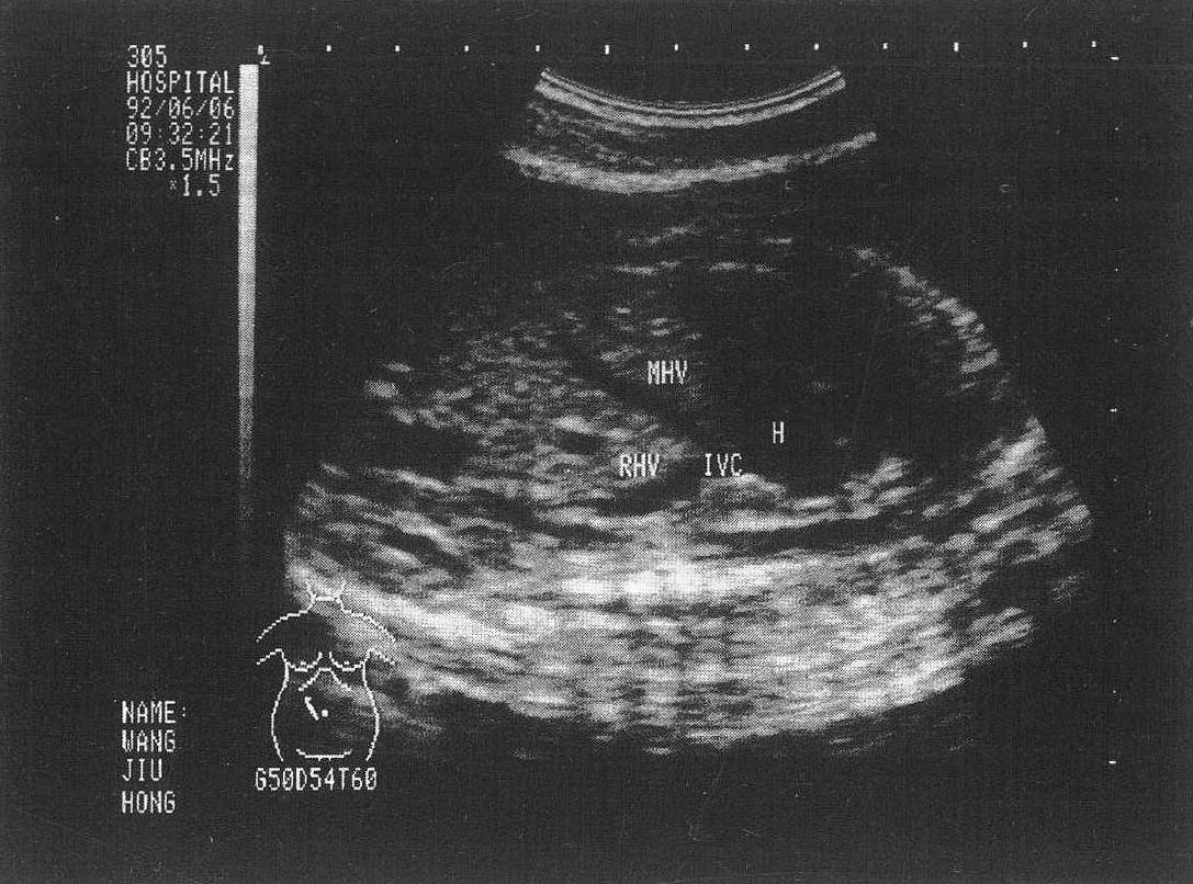 图6-25、26 胎儿肝脏声像图