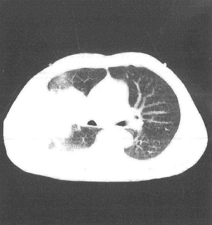 第一节 中心型肺癌