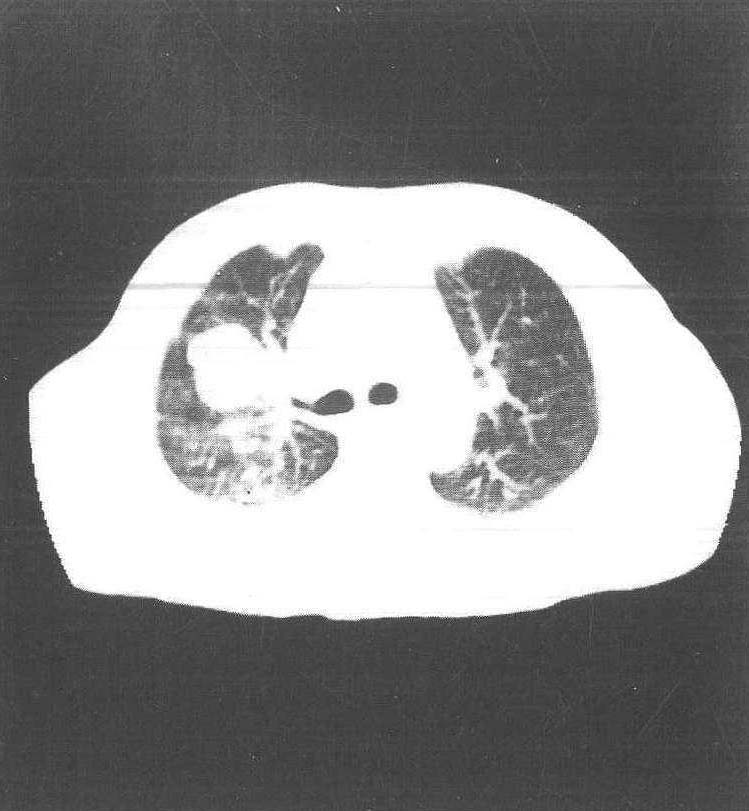 第二节 周围型肺癌