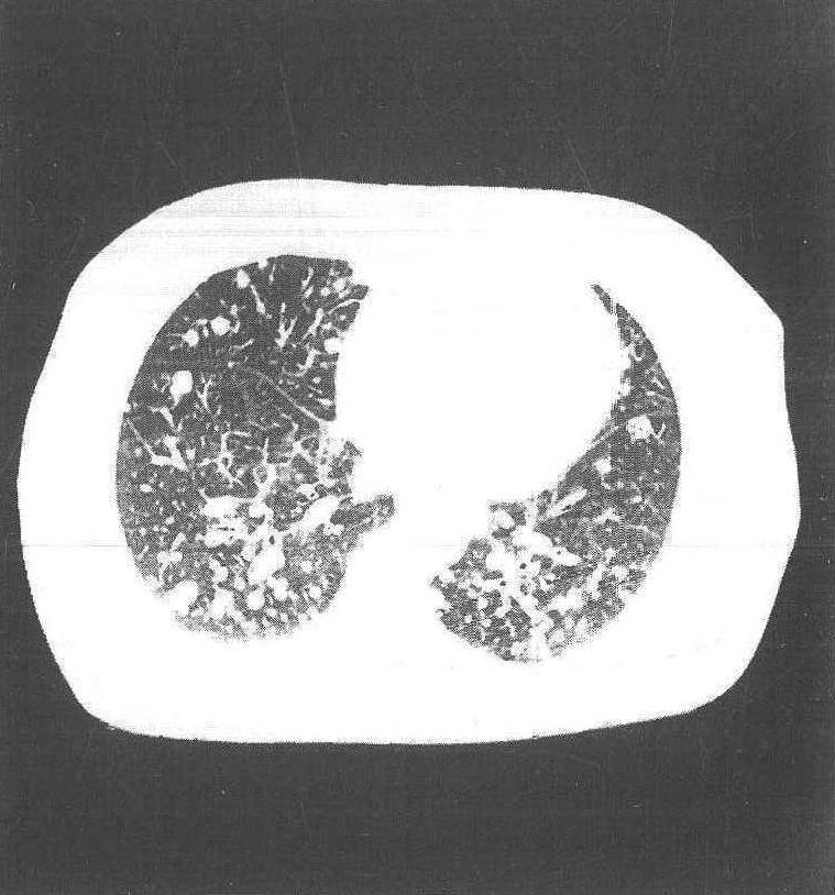 第三节 肺泡肺癌