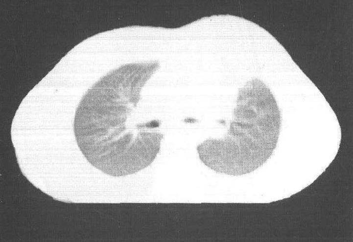 第四節(jié) 胸膜、胸壁良性腫瘤