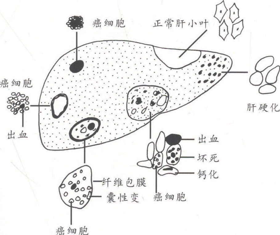 第二節(jié) 肝細(xì)胞癌