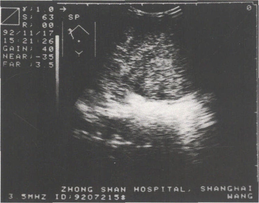 第三節(jié) 肝臟其他原發(fā)性惡性腫瘤