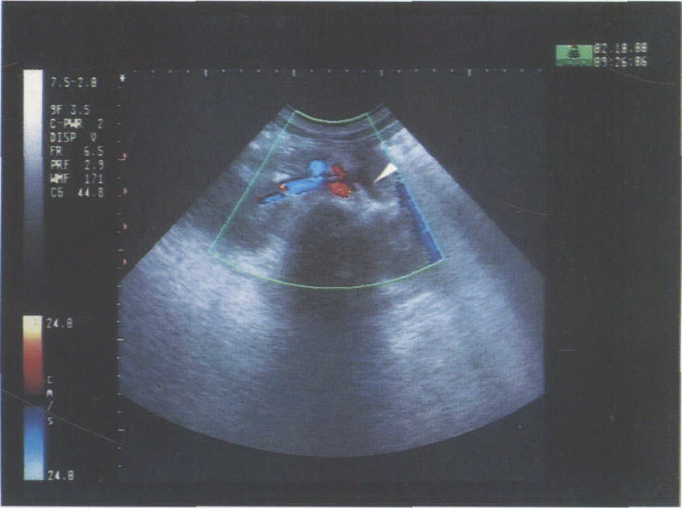左肾静脉超声图片图片