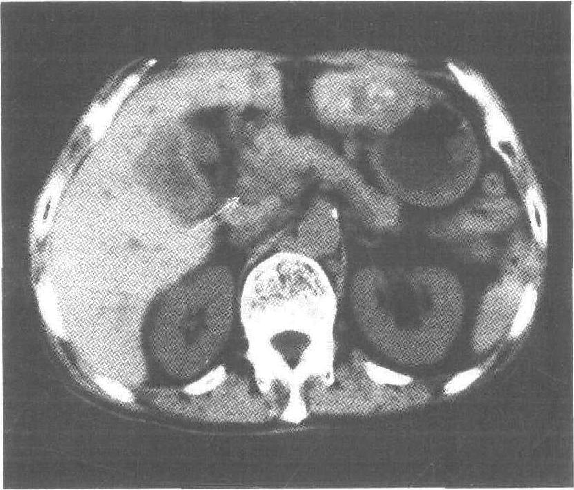 胰头癌声像图表现图片
