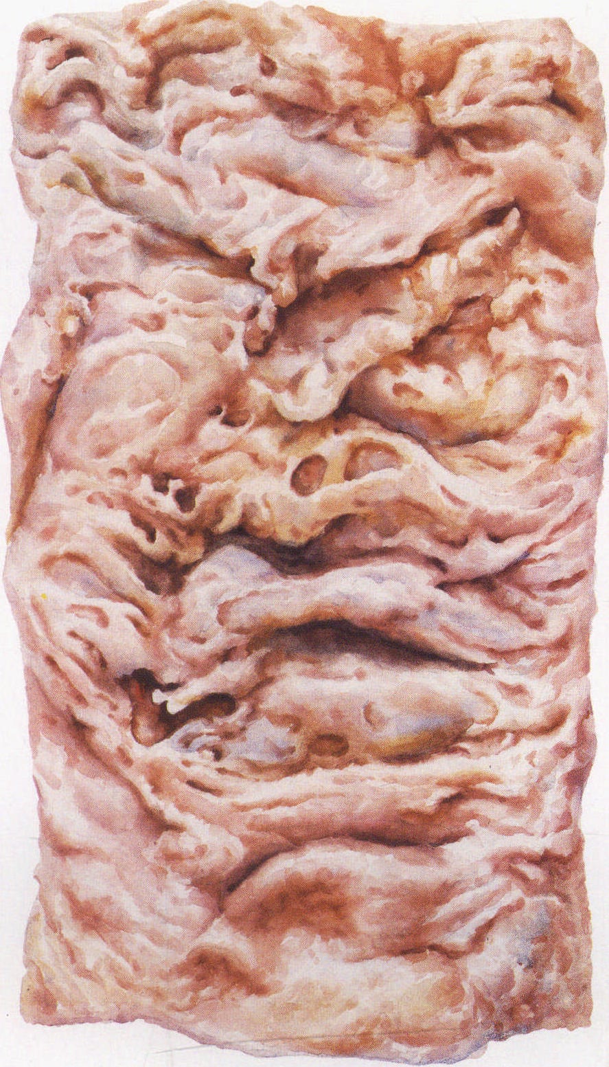 16. 阿米巴結(jié)腸病變