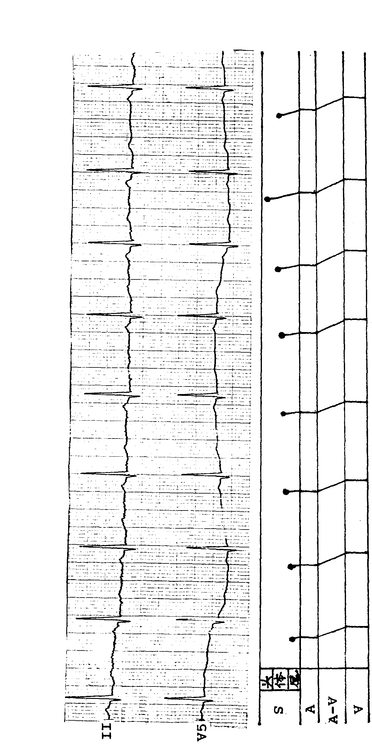 第6例 窦房结内游走性心律