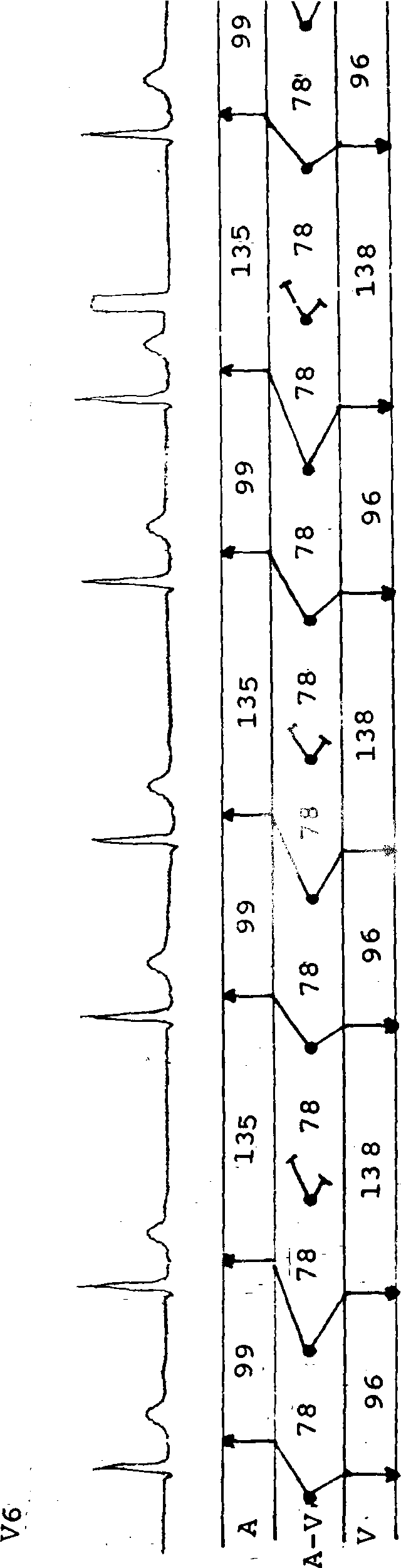 第28例 加速的交界性逸搏心律伴文氏型3∶2傳出阻滯