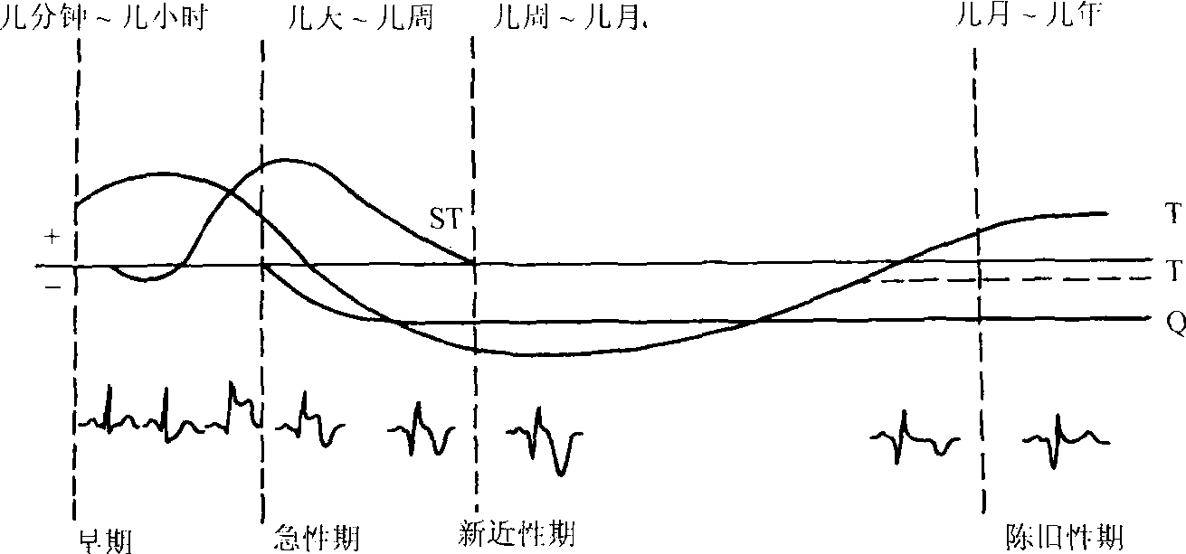 第二節(jié) 心肌梗死心電圖分期