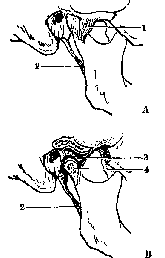 颞下颌关节画图图片