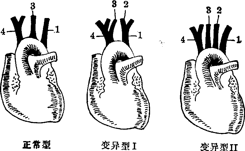 主动脉隆凸图片