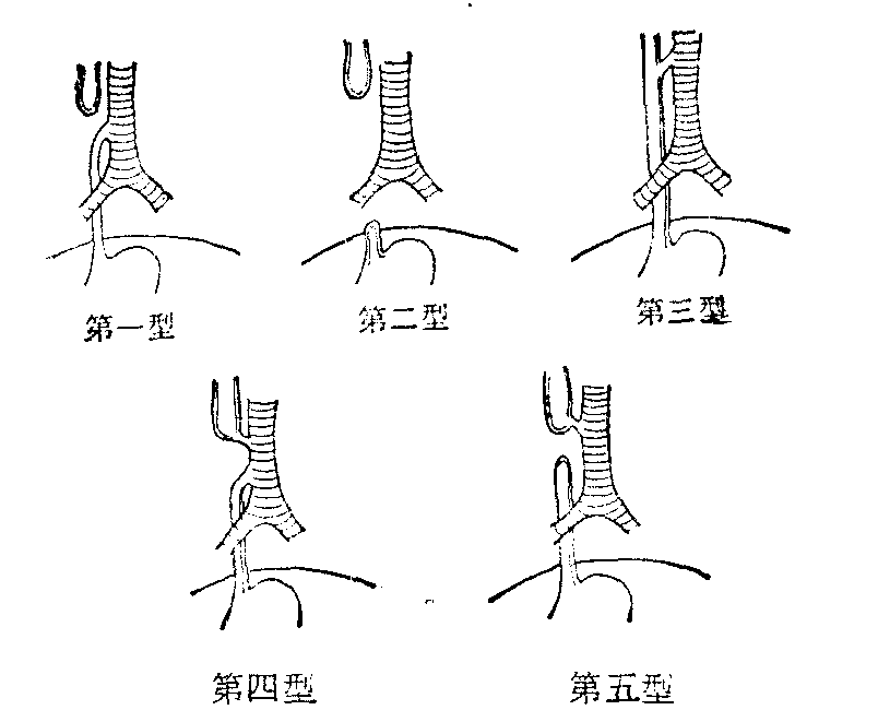 先天性食管闭锁与食管气管瘘