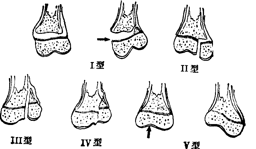 小儿骨折特殊类型
