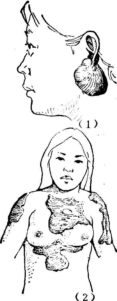瘢痕疙瘩