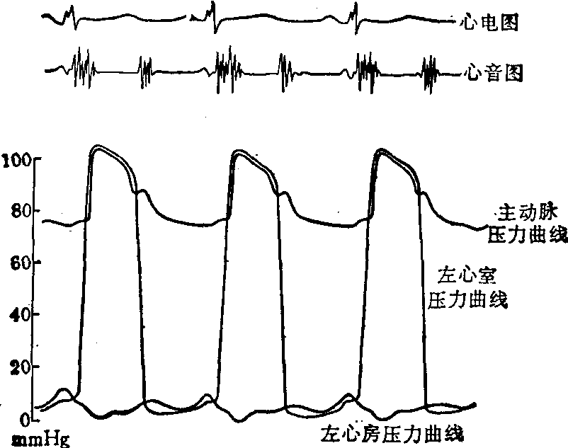 左心导管检查